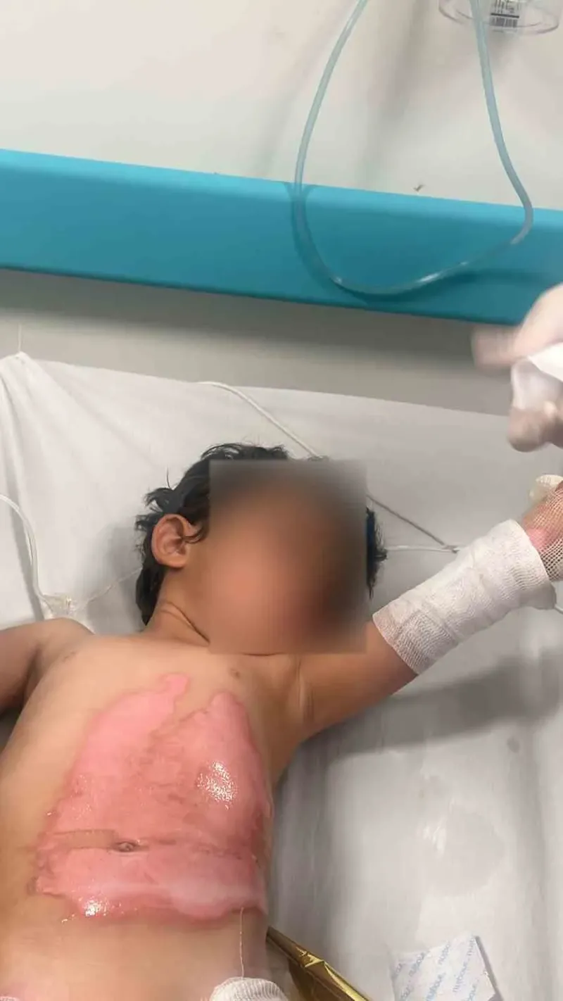 3 yaşındaki kızın üzerine kaynar su döküldü
