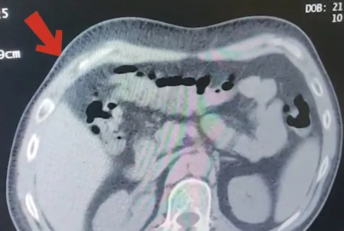 Mide ve bağırsaklarından 608 gram metamfetamin çıktı