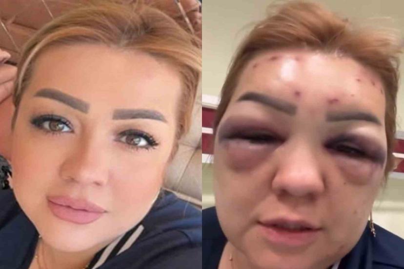 Bir Botokszade daha! Bu hale geldi