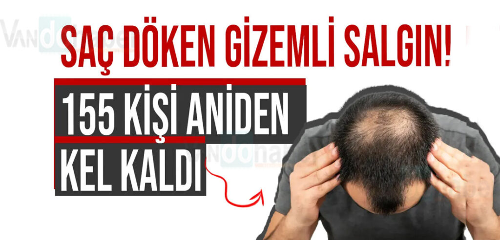 155 kişi aniden kel kaldı